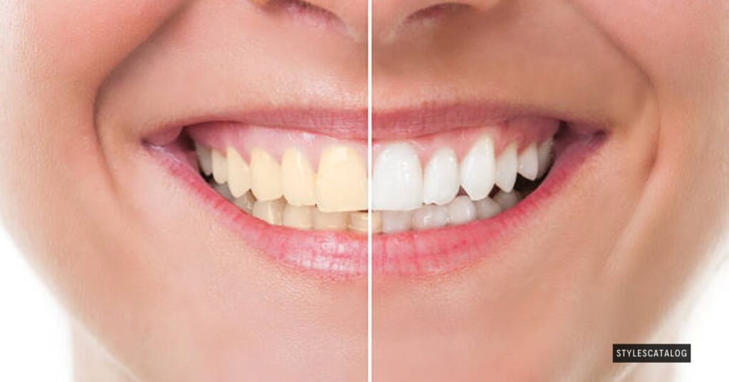 How To Get White Teeth Fast 7 Basic Hints