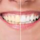 How To Get White Teeth Fast 7 Basic Hints